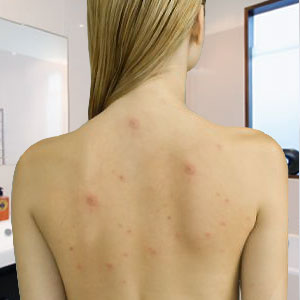 Dealing with Back Acne